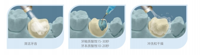 磷酸酸蚀剂操作.png
